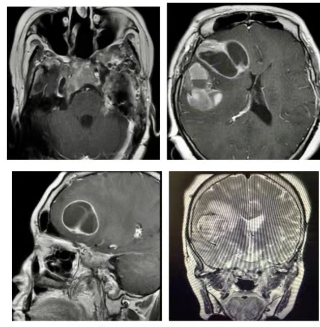 右额叶转移性垂体癌患者，经手术后得到有效治疗