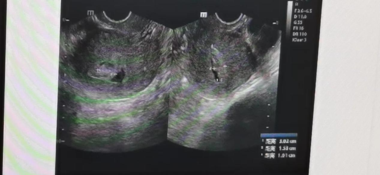 一位孕19+3周自然流产患者的治疗过程