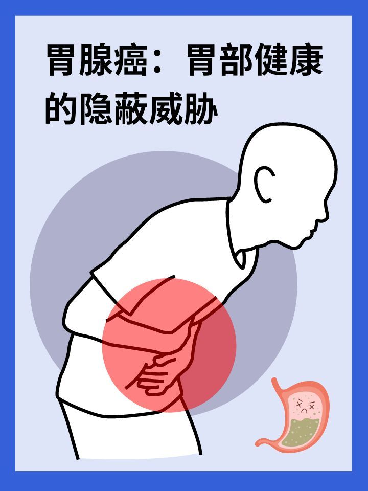 胃腺癌：胃部健康的隐蔽威胁