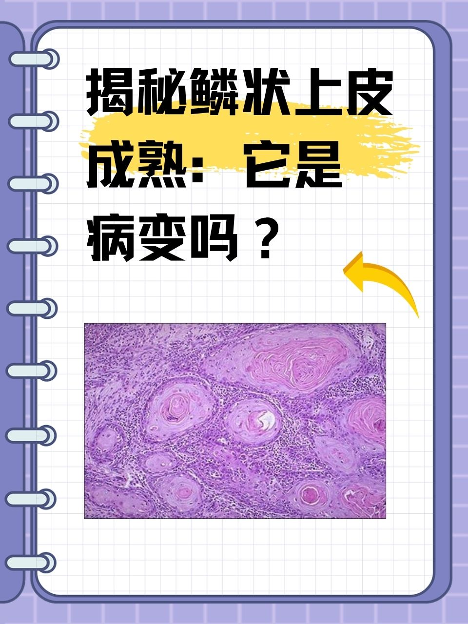 揭秘鳞状上皮成熟：它是病变吗？