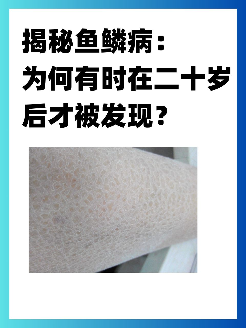 揭秘鱼鳞病：为何有时在二十岁后才被发现？