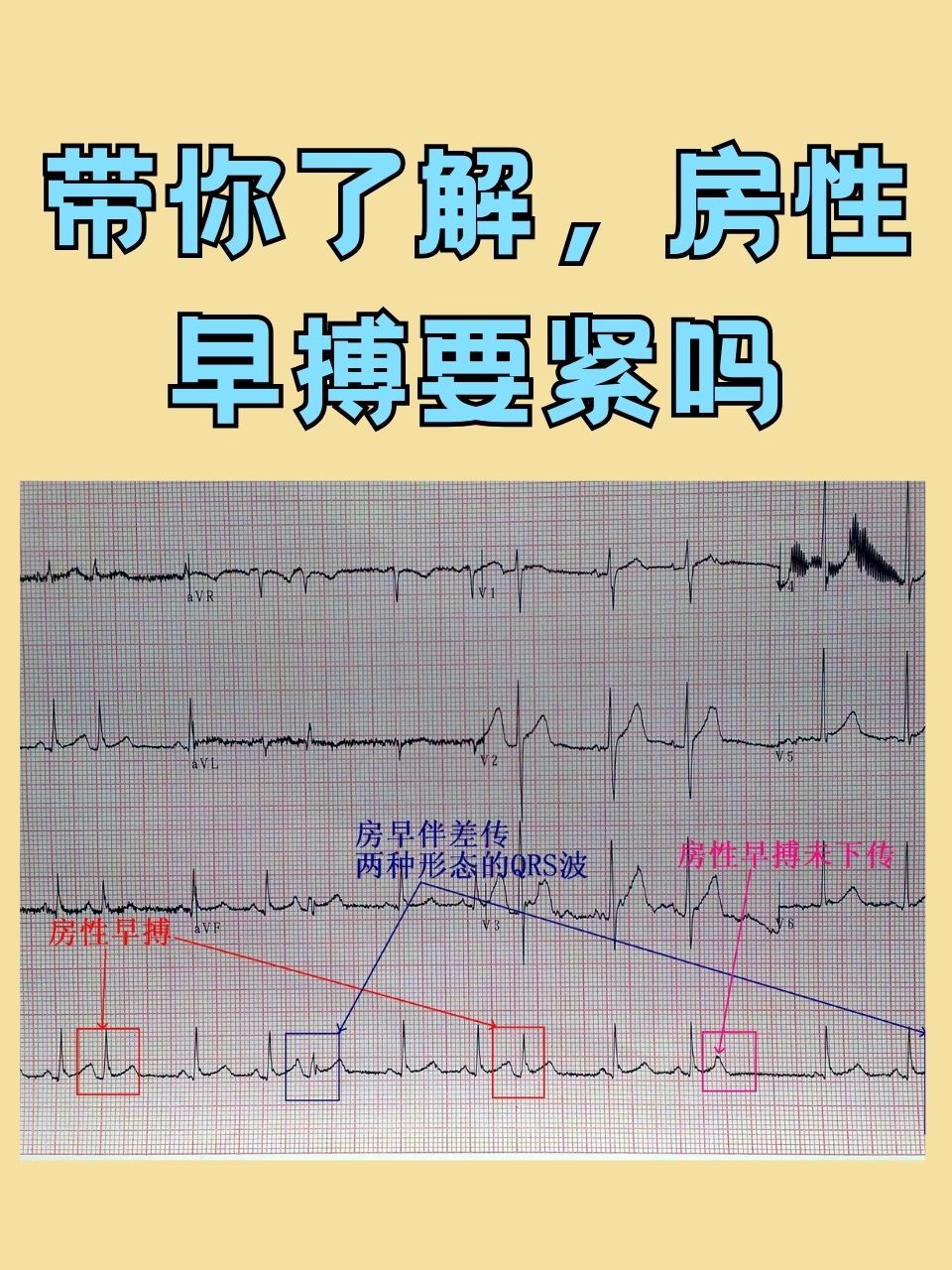 带你了解，房性早搏要紧吗