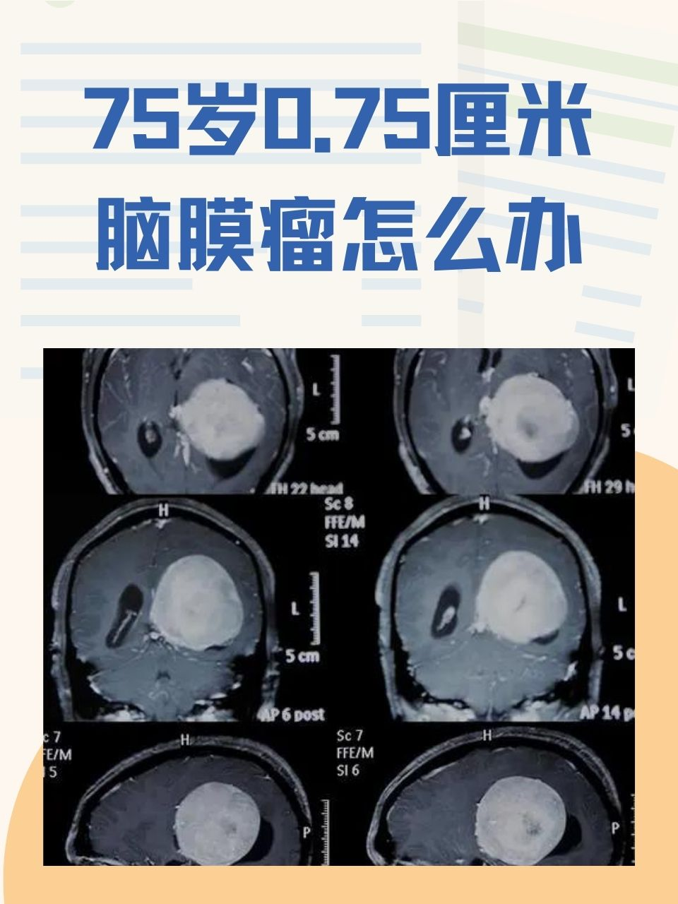 75岁0.75厘米脑膜瘤怎么办