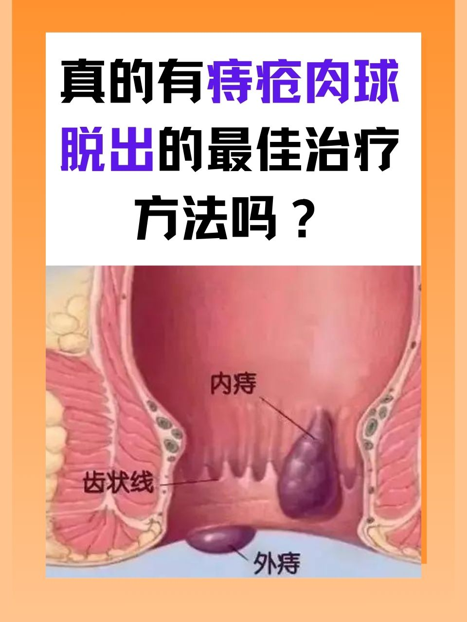 真的有痔疮肉球脱出的最佳治疗方法吗？