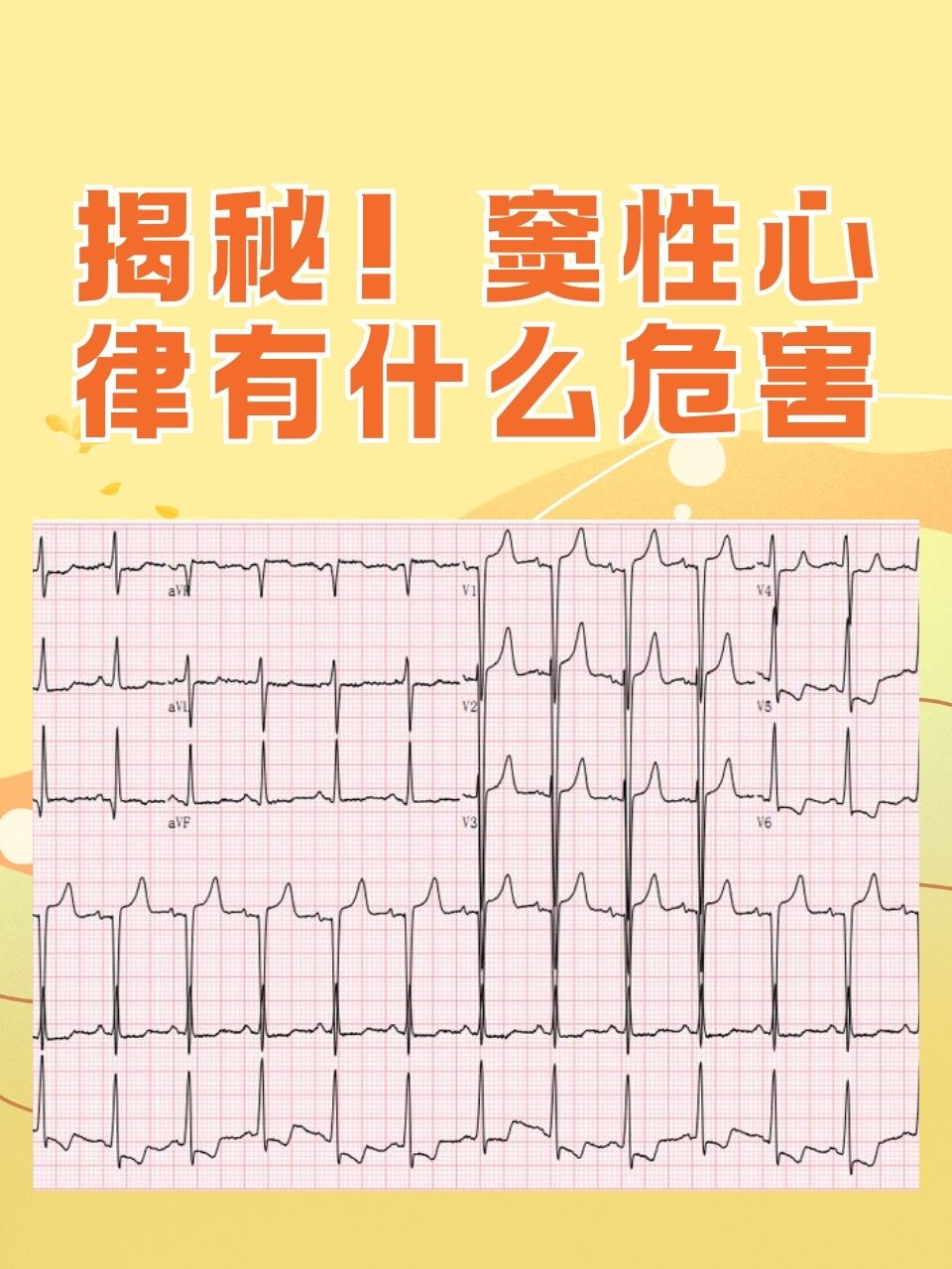 揭秘！窦性心律有什么危害