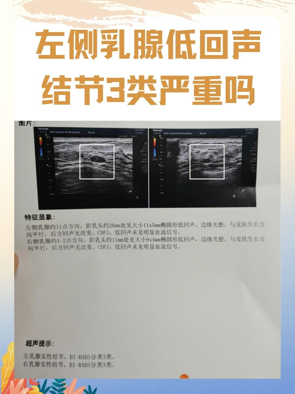 左侧乳腺低回声结节3类严重吗