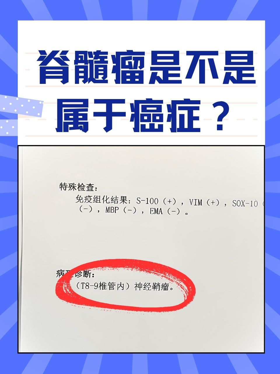 脊髓瘤是不是属于癌症？