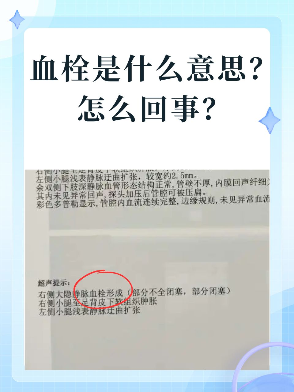 血栓是什么意思？怎么回事？