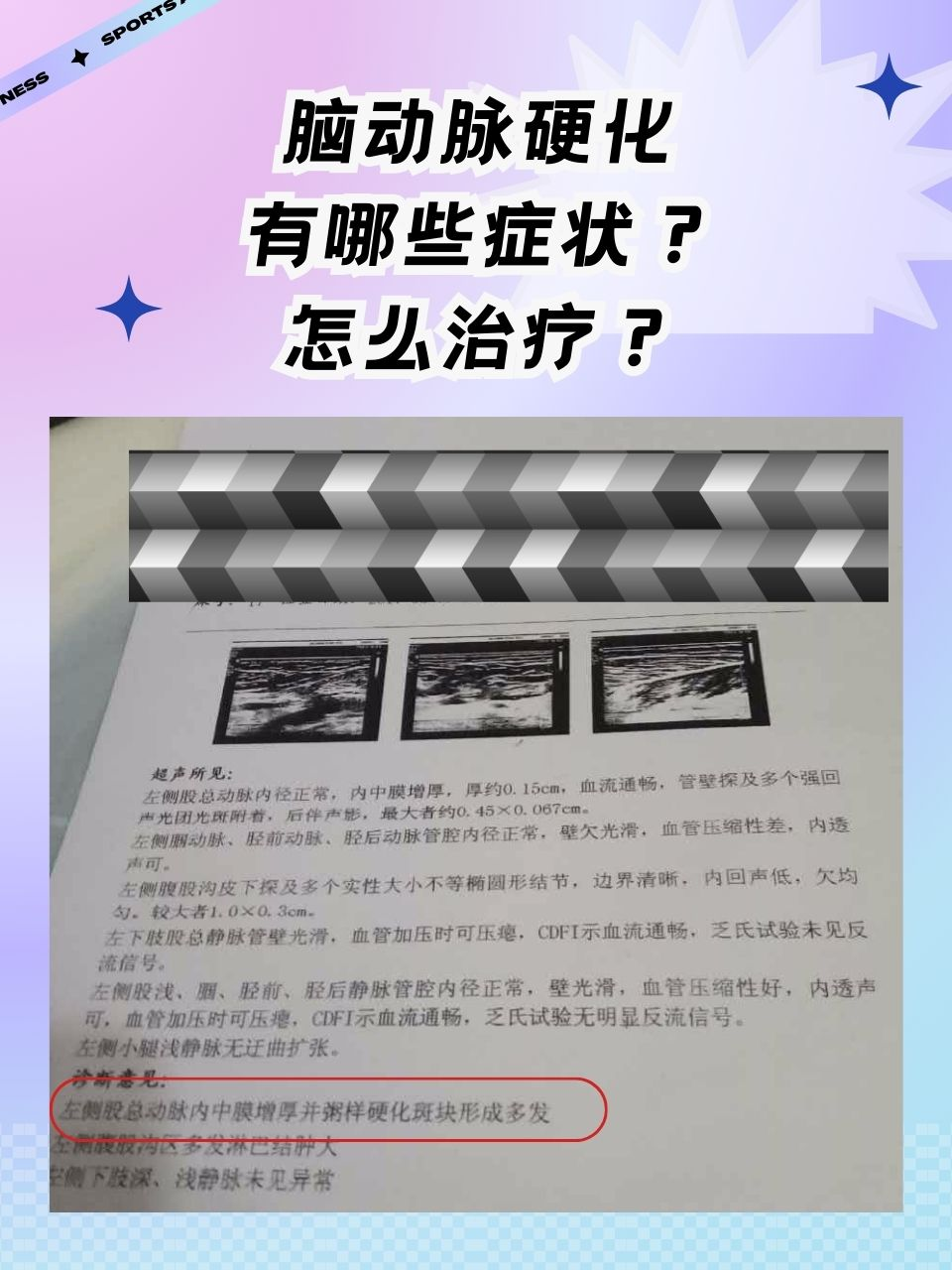 脑动脉硬化有哪些症状？怎么治疗？