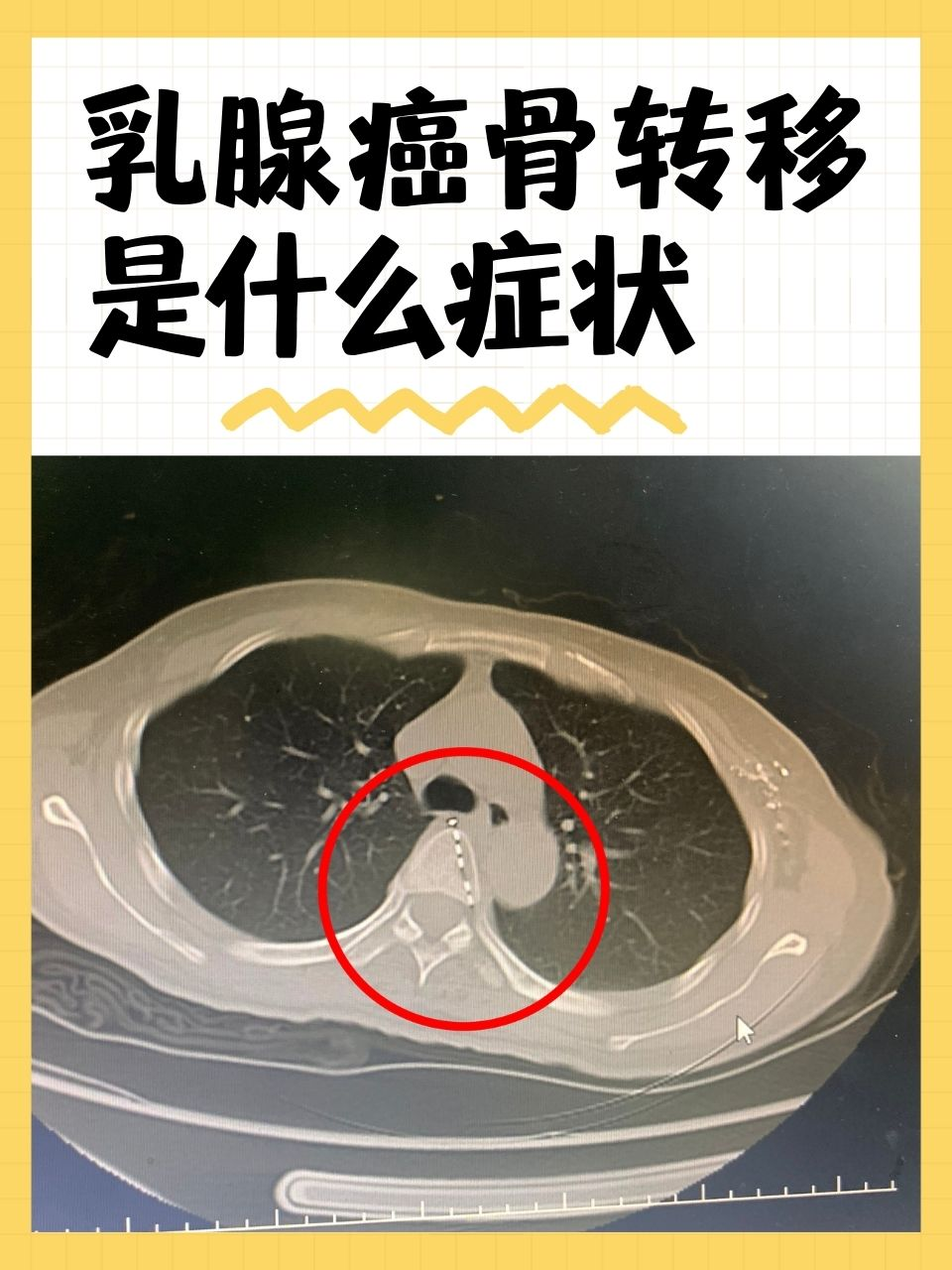 乳腺癌骨转移是什么症状