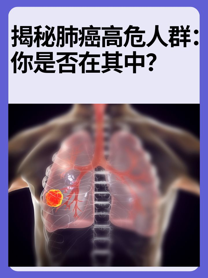 揭秘肺癌高危人群：你是否在其中？