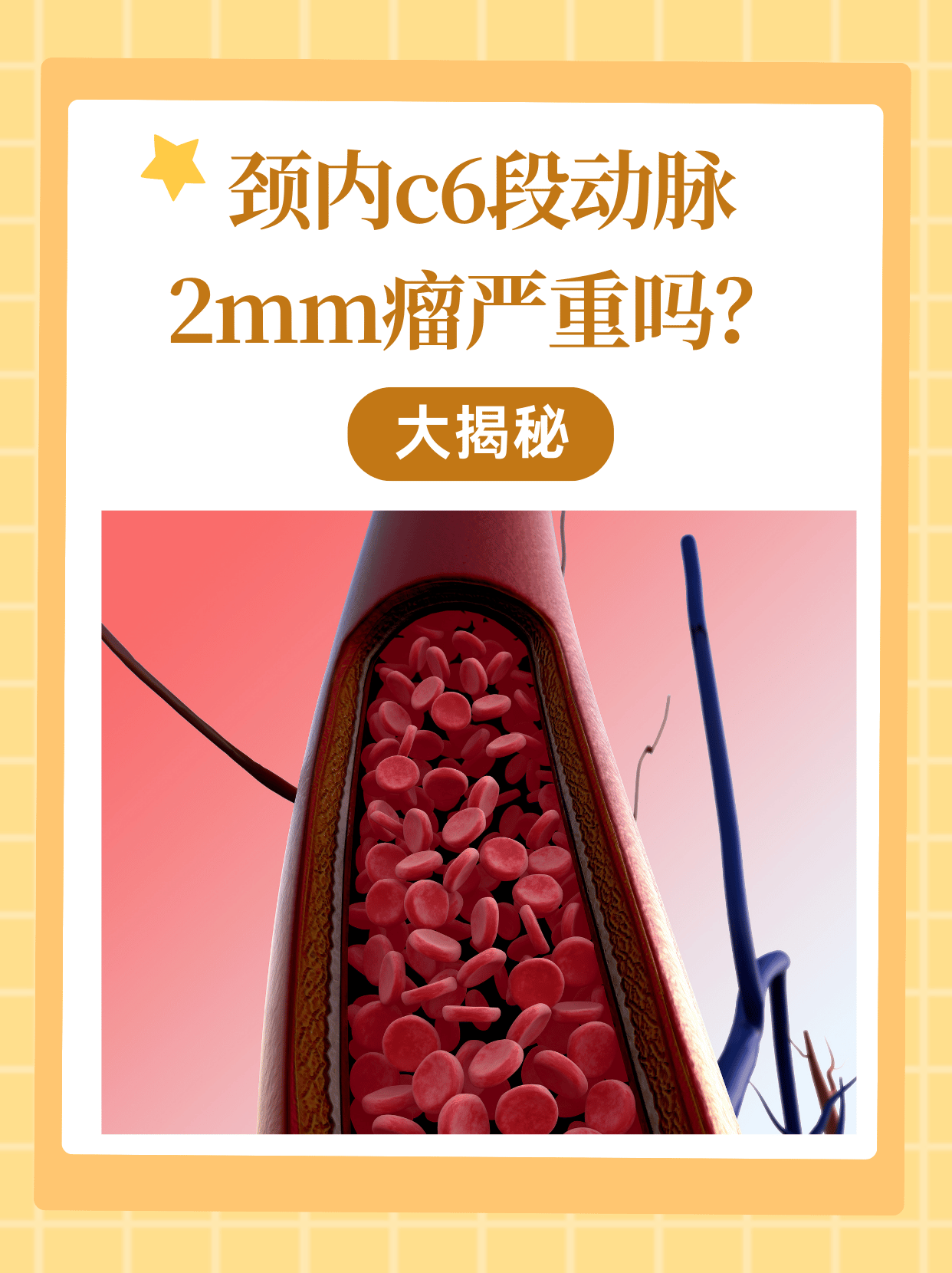 颈内C6段动脉2mm瘤严重吗？大揭秘