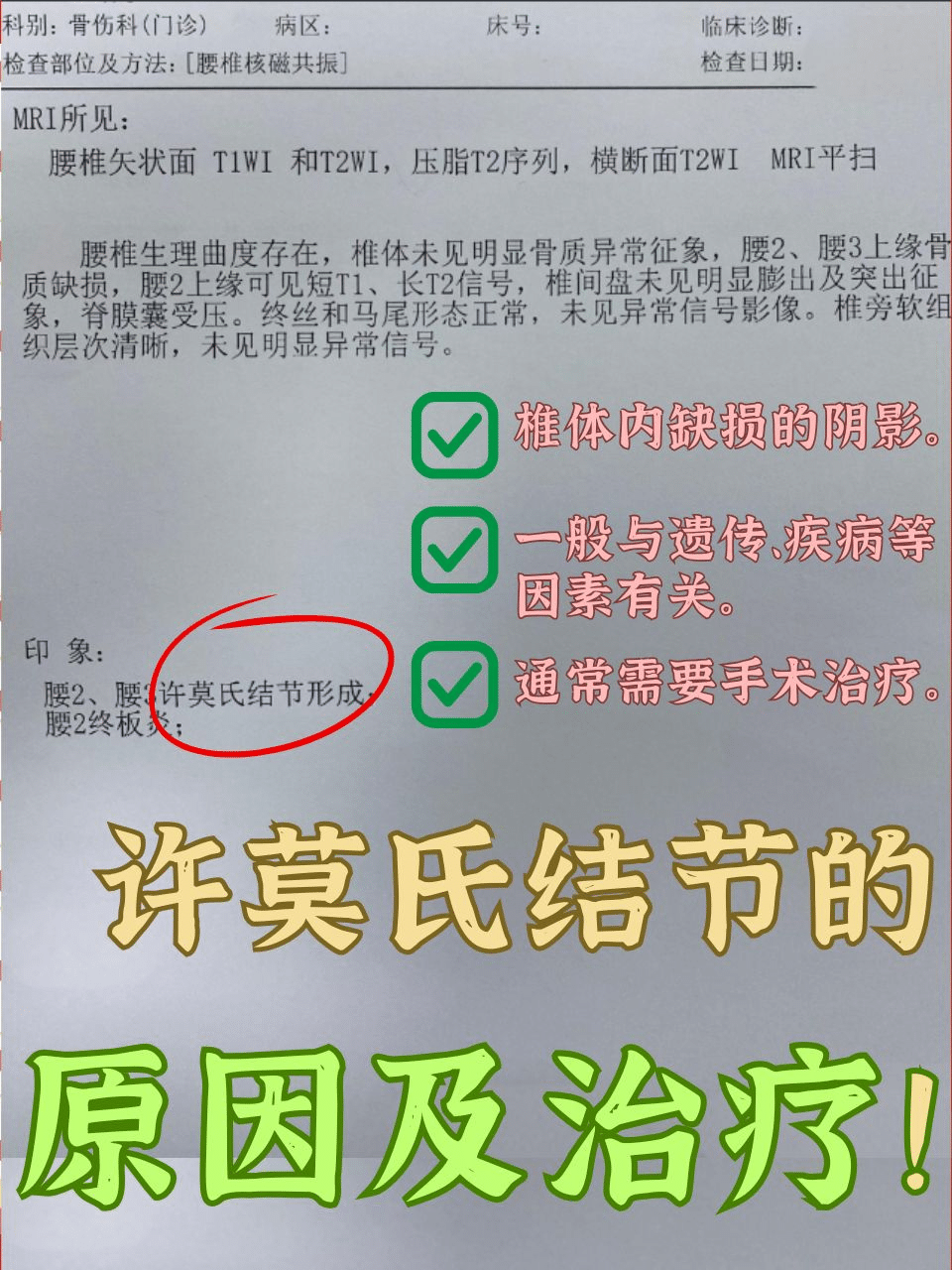 轻松了解许莫氏结节，健康从此不再遥远！