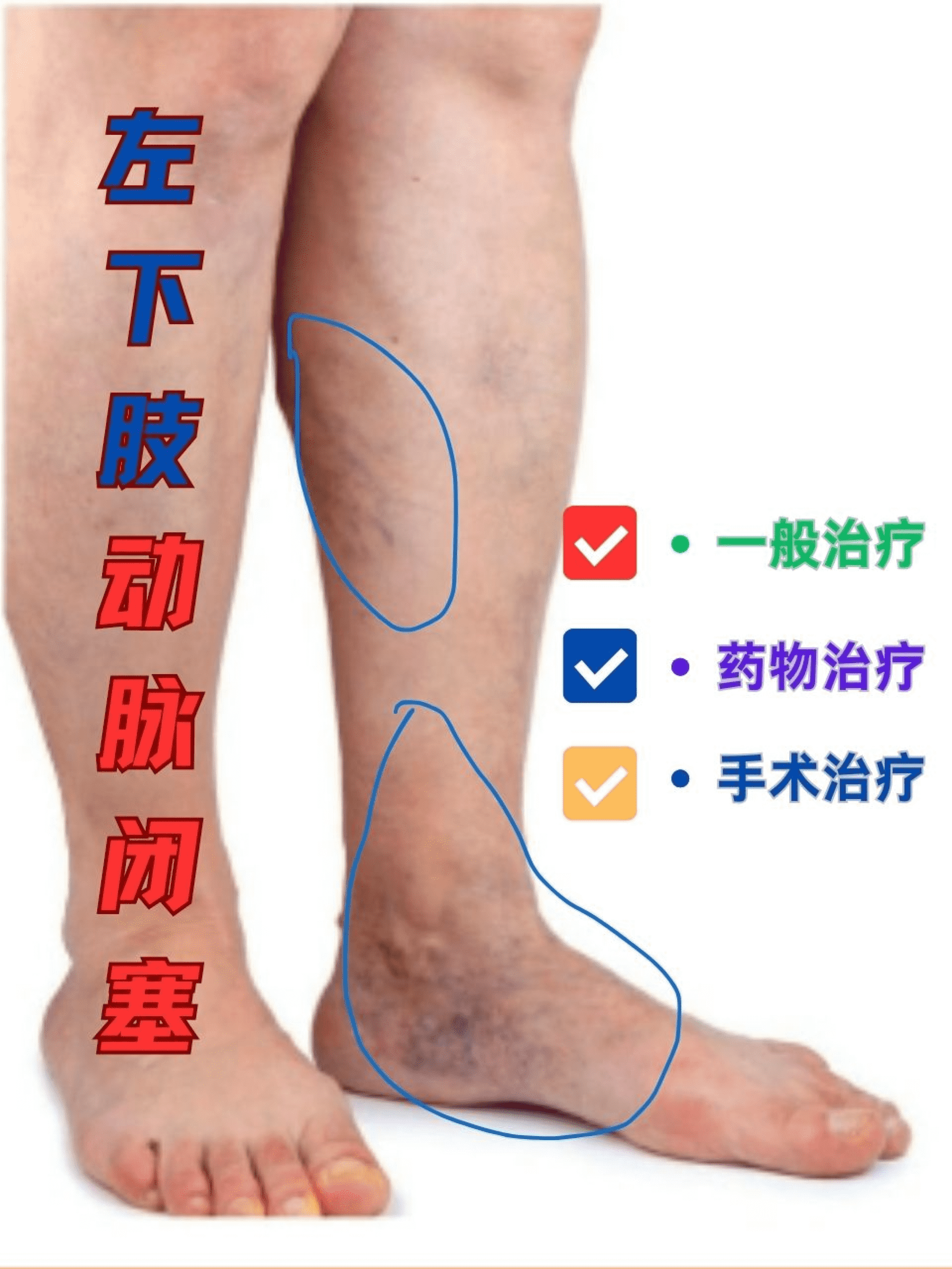 左下肢动脉闭塞患者必看！治疗方法在这里